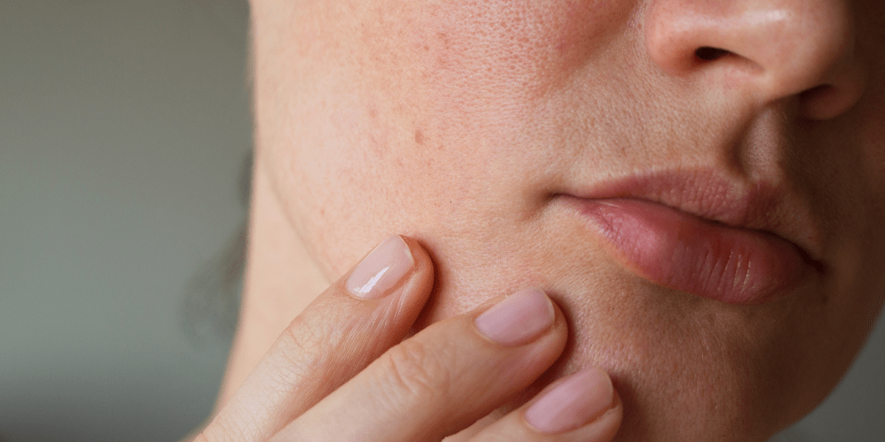 Woman with uneven complexion touching her face