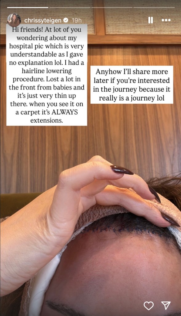chrissy-teigen-startles-fans-with-graphic-photo-of-bandaged-face